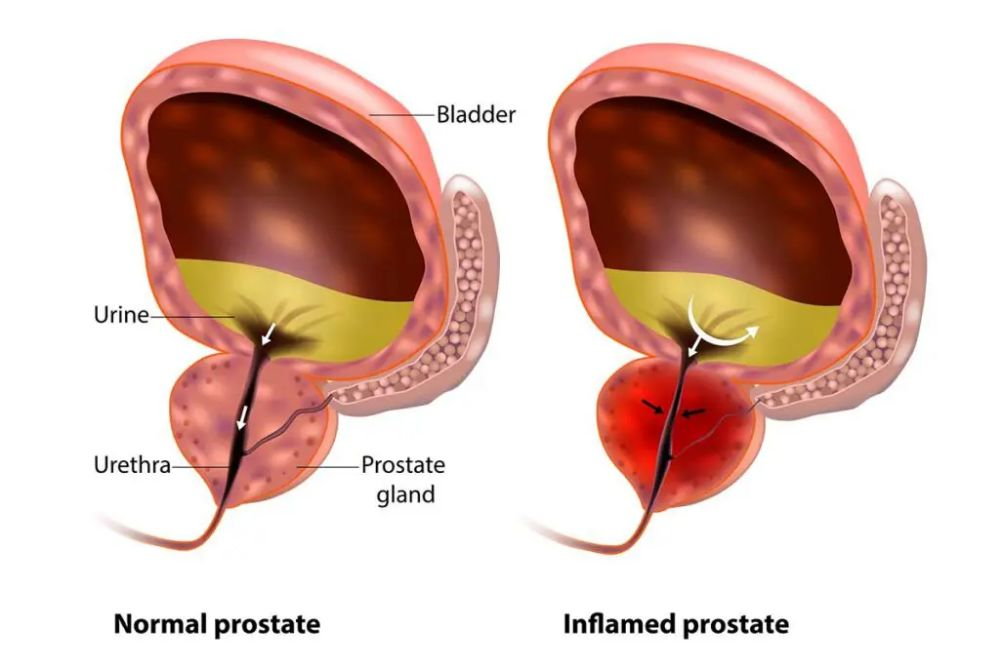 USG of Whole Abdomen with PVR, Prostate & MCC