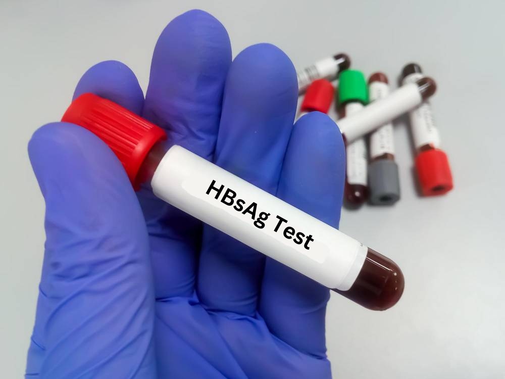 HBsAg (ELISA)